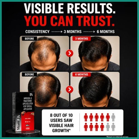 Morr F 5% HAIR SOLUTION, image 3